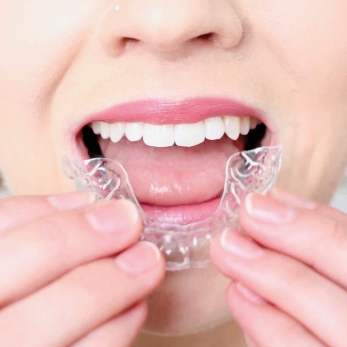Smilelign Clear Aligners – S4S Dental
